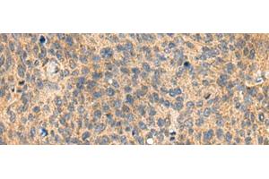 Immunohistochemistry of paraffin-embedded Human cervical cancer tissue using MIA Polyclonal Antibody at dilution of 1:100(x200) (MIA Antikörper)