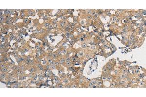 Immunohistochemistry of paraffin-embedded Human breast cancer using PPP2CB Polyclonal Antibody at dilution of 1:50 (PPP2CB Antikörper)