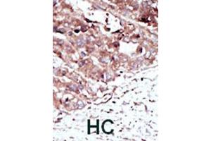Formalin-fixed and paraffin-embedded human hepatocellular carcinoma tissue reacted with PHKG2 polyclonal antibody  , which was peroxidase-conjugated to the secondary antibody, followed by AEC staining. (PHKG2 Antikörper  (N-Term))