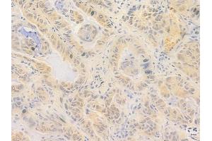 ABIN7096998 and ABIN7101065 at 1/100 staining human lung adenocarcinoma by IHC-P. (ZNF574 Antikörper)