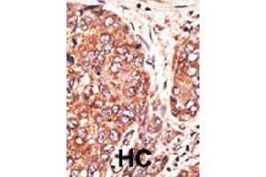 Formalin-fixed and paraffin-embedded human hepatocellular carcinoma tissue reacted with MAFK polyclonal antibody  , which was peroxidase-conjugated to the secondary antibody, followed by AEC staining. (Septin 9 Antikörper  (C-Term))