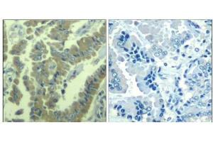 Immunohistochemical analysis of paraffin-embedded human lung carcinoma tissue using MARCKS(Phospho-Ser170) Antibody(left) or the same antibody preincubated with blocking peptide(right). (MARCKS Antikörper  (pSer170))
