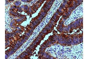 Immunohistochemistry staining of human colon adenocarcinoma (paraffin sections) using anti-blood group Lewis b (clone 2-25LE). (Blood Group Lewis B Antikörper)