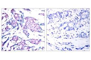 Immunohistochemical analysis of paraffin-embedded human breast carcinoma tissue using c-Jun (phospho-Thr93) antibody (E011022). (C-JUN Antikörper  (pThr93))