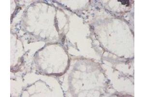 Immunohistochemistry of paraffin-embedded human colon cancer using ABIN7177353 at dilution of 1:20 (IL18BP Antikörper  (AA 29-193))