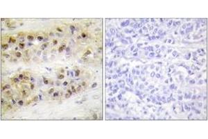 Immunohistochemistry analysis of paraffin-embedded human breast carcinoma tissue, using RORA Antibody. (RORA Antikörper  (AA 6-55))