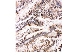 Anti-Bag3 antibody, IHC(P) IHC(P): Human Intestinal Cancer Tissue