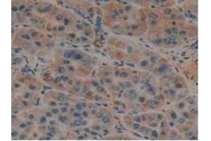 IHC-P analysis of Human Liver Cancer Tissue, with DAB staining. (PLAUR Antikörper  (AA 13-114))