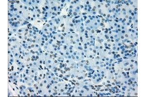 Immunohistochemical staining of paraffin-embedded Adenocarcinoma of colon tissue using anti-NAT8mouse monoclonal antibody. (NAT8 Antikörper)