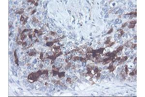 Immunohistochemical staining of paraffin-embedded Adenocarcinoma of Human breast tissue using anti-SERPINB2 mouse monoclonal antibody. (SERPINB2 Antikörper)