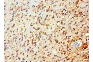 Immunohistochemistry of paraffin-embedded human glioma using ABIN7144651 at dilution of 1:100 (ARNT2 Antikörper  (AA 440-690))