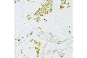 Immunohistochemistry of paraffin-embedded human lung cancer using SIRT2 antibody (ABIN6291363) at dilution of 1:100 (40x lens). (SIRT2 Antikörper)