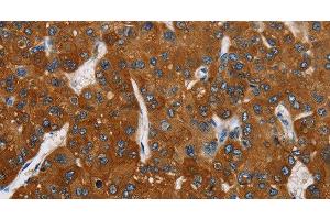 Immunohistochemistry of paraffin-embedded Human liver cancer tissue using CARD9 Polyclonal Antibody at dilution 1:70 (CARD9 Antikörper)