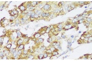 Immunohistochemistry of paraffin-embedded Human liver cancer using ECH1 Polyclonal Antibody at dilution of 1:150 (40x lens).