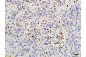 Formalin-fixed and paraffin embedded rat hepatoma labeled with Anti-CXCR2/CD182 Polyclonal Antibody, Unconjugated (ABIN732218) followed by conjugation to the secondary antibody and DAB staining (CXCR2 Antikörper  (AA 316-360))