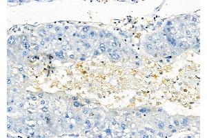 ABIN6258088 and ABIN6273896 at 1/100 staining Human liver cancer by IHC-P. (GPR81 Antikörper  (C-Term))