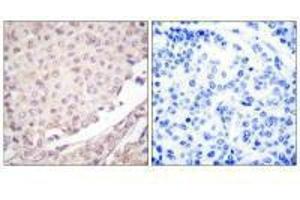 Immunohistochemical analysis of paraffin-embedded human lung carcinoma tissue using Cullin 1 antibody. (Cullin 1 Antikörper)