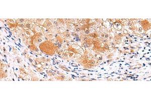Immunohistochemistry of paraffin-embedded Human liver cancer tissue using ITSN2 Polyclonal Antibody at dilution of 1:40(x200) (Intersectin 2 Antikörper)