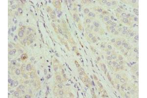 Immunohistochemistry of paraffin-embedded human liver cancer using ABIN7144067 at dilution of 1:100 (CIAPIN1 Antikörper  (AA 1-312))