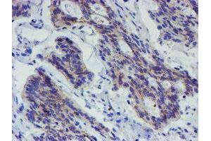 Immunohistochemical staining of paraffin-embedded Carcinoma of Human pancreas tissue using anti-LRRC25 mouse monoclonal antibody. (LRRC25 Antikörper)
