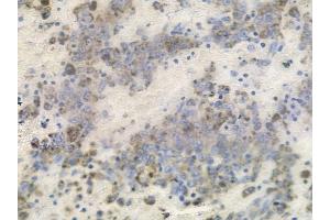 ABIN6256027 and ABIN6267368 at 1/100 staining human melanoma by IHC-P. (FGFR1 Antikörper  (pTyr766))