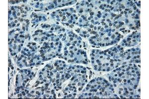 Immunohistochemical staining of paraffin-embedded Adenocarcinoma of breast tissue using anti-CRYAB mouse monoclonal antibody. (CRYAB Antikörper)
