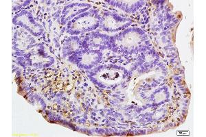 Formalin-fixed and paraffin embedded human colon carcinoma labeled with Rabbit Anti NALP4 Polyclonal Antibody, Unconjugated (ABIN872353) at 1:200 followed by conjugation to the secondary antibody and DAB staining (NLRP4 Antikörper  (AA 351-450))