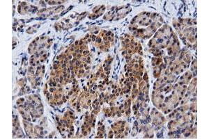 Immunohistochemical staining of paraffin-embedded Carcinoma of Human kidney tissue using anti-CBWD1 mouse monoclonal antibody. (CBWD1 Antikörper)