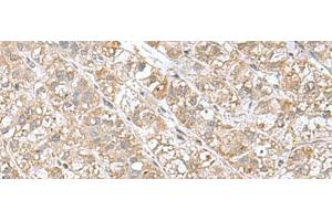Immunohistochemistry of paraffin-embedded Human liver cancer tissue using EIF1AY Polyclonal Antibody at dilution of 1:55(x200) (EIF1AY Antikörper)