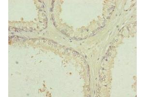 Immunohistochemistry of paraffin-embedded human prostate cancer using ABIN7151092 at dilution of 1:100 (RNF41 Antikörper  (AA 1-317))
