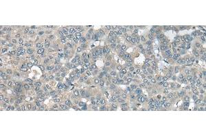 Immunohistochemistry of paraffin-embedded Human liver cancer tissue using UCN3 Polyclonal Antibody at dilution of 1:55(x200)