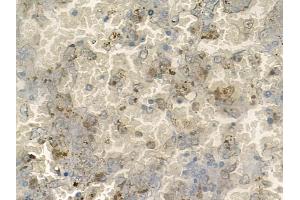 ABIN6260113 and ABIN6272523 at 1/100 staining human melanoma by IHC-P. (ATOH8 Antikörper  (C-Term))