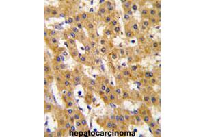 Formalin-fixed and paraffin-embedded human hepatocarcinomareacted with PDHX polyclonal antibody , which was peroxidase-conjugated to the secondary antibody, followed by AEC staining. (PDHX Antikörper  (Thr11))