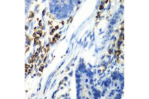 Immunohistochemistry of paraffin-embedded human colon carcinoma using  antibody (ABIN6127458, ABIN6137179, ABIN6137181 and ABIN6222596) at dilution of 1:100 (40x lens). (Asialoglycoprotein Receptor 1 Antikörper  (AA 1-150))