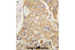 Formalin-fixed and paraffin-embedded human lung carcinomareacted with ADCY2 polyclonal antibody , which was peroxidase-conjugated to the secondary antibody, followed by AEC staining. (ADCY2 Antikörper  (C-Term))