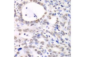 Immunohistochemistry of paraffin-embedded human gastric cancer using Nono Antibody. (NONO Antikörper  (AA 1-300))