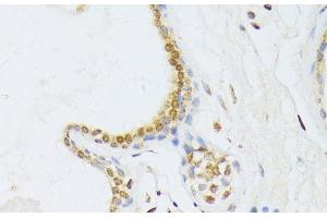 Immunohistochemistry of paraffin-embedded Human breast cancer using ANKRD52 Polyclonal Antibody at dilution of 1:100 (40x lens). (ANKRD52 Antikörper)