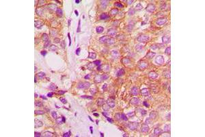 Immunohistochemical analysis of Filamin A staining in human breast cancer formalin fixed paraffin embedded tissue section.