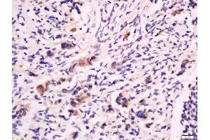 Formalin-fixed and paraffin embedded human colon cancer labeled with Anti-CD53 Polyclonal Antibody, Unconjugated  at 1:200 followed by conjugation to the secondary antibody and DAB staining. (CD53 Antikörper  (AA 65-160))