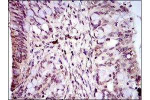 Immunohistochemical analysis of paraffin-embedded rectum cancer tissues using PIWIL4 mouse mAb with DAB staining.