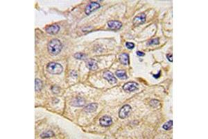 IHC analysis of FFPE human lung carcinoma tissue stained with anti-TLR2 antibody