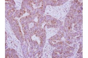 IHC-P Image Immunohistochemical analysis of paraffin-embedded human colon carcinoma, using IL10 Receptor alpha, antibody at 1:250 dilution.