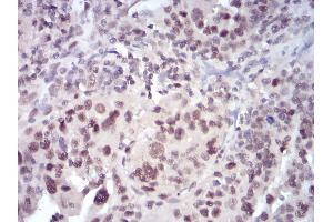 Immunohistochemical analysis of paraffin-embedded human ovarian cancer tissues using SELL mouse mAb with DAB staining. (L-Selectin Antikörper  (AA 83-186))