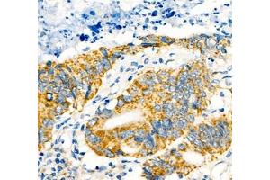 Immunohistochemistry of paraffin embedded human colon cancer using Notch4 (ABIN7074863) at dilution of 1:600 (400x lens)