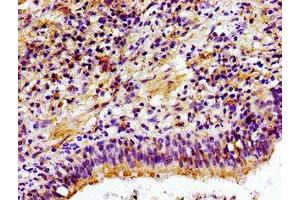 Immunohistochemistry of paraffin-embedded human lung cancer using ABIN7147616 at dilution of 1:100 (Choline Kinase alpha Antikörper  (AA 79-173))