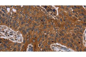 Immunohistochemistry of paraffin-embedded Human lung cancer using Catenin gamma Polyclonal Antibody at dilution of 1:40 (JUP Antikörper)