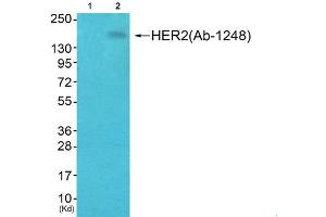Immunohistochemical analysis of paraffin-embedded human breast carcinoma tissue, using HER2 (phospho-Tyr1248) antibody. (ErbB2/Her2 Antikörper  (pTyr1248))