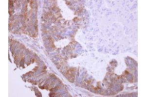 IHC-P Image BHMT antibody detects BHMT protein at cytosol on human colon carcinoma by immunohistochemical analysis. (BHMT Antikörper)