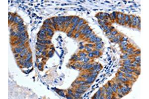 The image on the left is immunohistochemistry of paraffin-embedded Human colon cancer tissue using ABIN7128939(CHRM2 Antibody) at dilution 1/3, on the right is treated with fusion protein. (Muscarinic Acetylcholine Receptor M2 Antikörper)