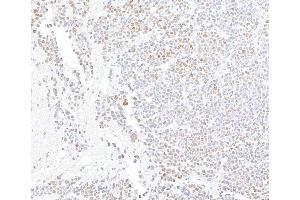 Immunohistochemistry (IHC) image for anti-AT Rich Interactive Domain 1A (SWI-Like) (ARID1A) (AA 750-800) antibody (ABIN7795678)